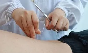 Відгуки пацієнтів про акупунктуру при грижі хребта (відгуки голковколювання при грижі хребта пацієнт лікувальний ефект больовий синдром) Відгуки пацієнтів про акупунктуру при грижі хребта