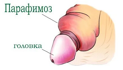 Парафімоз у хлопчиків і чоловіків (парафимоз у чоловіків) Парафімоз у хлопчиків і чоловіків
