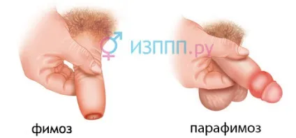 Парафімоз лікування, причини, у хлопчиків, чоловіків (лікування) Парафімоз лікування, причини, у хлопчиків, чоловіків