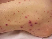 Сучасна класифікація і види сепсису