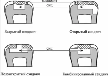 Сучасні аспекти сендвіч-технології (міцнішим композитом) Сучасні аспекти сендвіч-технології