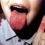 Спіноцеребеллярние атаксія типи розлади і його лікування (лікування) Спіноцеребеллярние атаксія типи розлади і його лікування