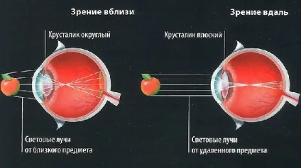 Спазм акомодації - що це таке лікування, симптоми помилкової короткозорості у дорослих (помилковою) Спазм акомодації - що це таке лікування, симптоми помилкової короткозорості у дорослих