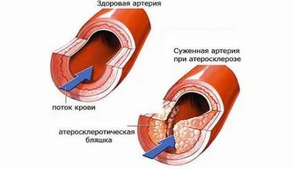 Спазм судин серця причини, симптоми, діагностика, лікування та профілактика (спазм) Спазм судин серця причини, симптоми, діагностика, лікування та профілактика