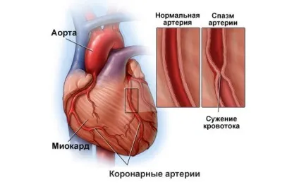 Спазм судин серця причини, симптоми, діагностика, лікування та профілактика (причини) Спазм судин серця причини, симптоми, діагностика, лікування та профілактика