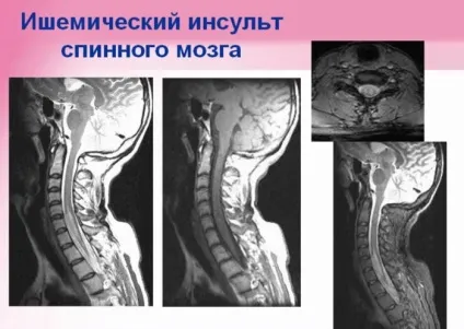 Спинальний інсульт що це таке, симптоми і лікування (симптоми) Спинальний інсульт що це таке, симптоми і лікування
