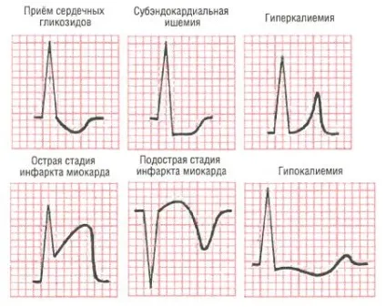 Специфічні і неспецифічні зміни комплексу st-t (комплексу) Специфічні і неспецифічні зміни комплексу st-t