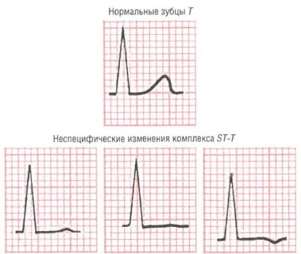 Специфічні і неспецифічні зміни комплексу st-t (неспецифічні) Специфічні і неспецифічні зміни комплексу st-t