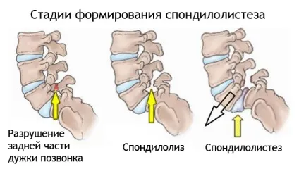 Спонділоліз l5, l4 хребця лікування і симптоми (причини) Спонділоліз l5, l4 хребця лікування і симптоми