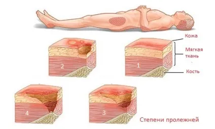 Стадії виникнення і розвитку пролежнів, їх симптоми, лікування і профілактика (стадії) Стадії виникнення і розвитку пролежнів, їх симптоми, лікування і профілактика