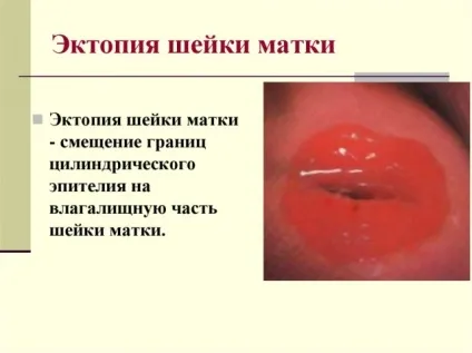 Стадії ерозії шийки матки (матки) Стадії ерозії шийки матки