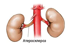 Стентування ниркових артерій