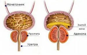 Стент в нирці