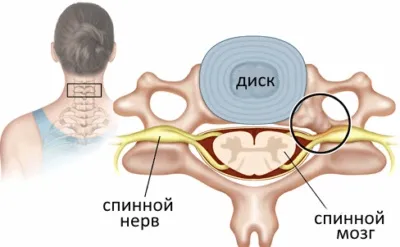 Стеноз хребетного каналу шийного відділу що це таке (каналу) Стеноз хребетного каналу шийного відділу що це таке