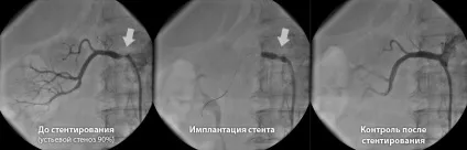 Стентування ниркових артерій
