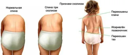 Ступеня сколіозу хребта як визначити, лікування у дітей та дорослих (хребта) Ступеня сколіозу хребта як визначити, лікування у дітей та дорослих