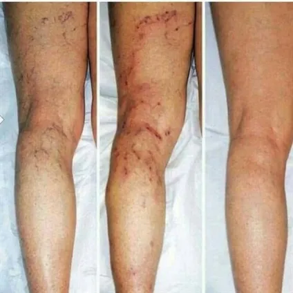 Ставлю п'явки з виїздом на будинок