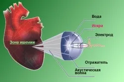 Субендокардіальних ішемія на ЕКГ