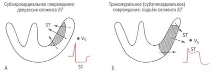 субендокардіальних ішемія