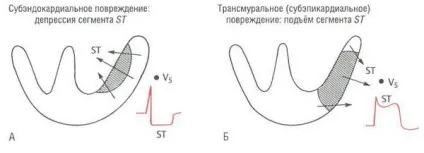 Субендокардіальних ішемія причини, симптоми, лікування (симптоми) Субендокардіальних ішемія причини, симптоми, лікування