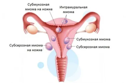 Субмукозних міоматозний вузол