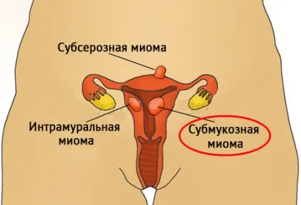 Субмукозних міоматозний вузол