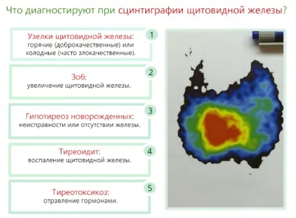 Сцинтиграфія щитовидної залози - як це роблять, що потрібно, запобіжні заходи і протипоказання (залози) Сцинтиграфія щитовидної залози - як це роблять, що потрібно, запобіжні заходи і протипоказання