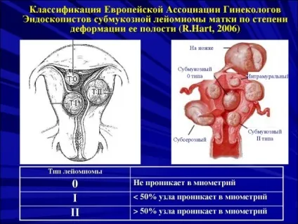 Субмукозних міоматозний вузол
