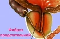 Суха шкіра на крайньої плоті (шкіри крайньої плоті) Суха шкіра на крайньої плоті