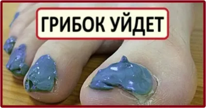 Сухі мозолі на пальцях ніг лікування різними способами (способами) Сухі мозолі на пальцях ніг лікування різними способами