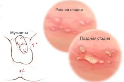 Сухість і лущення на шкірі статевого члена (інтимному місці чоловіків) Сухість і лущення на шкірі статевого члена