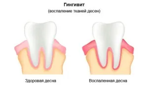 Перекис водню при зубному болю - як використовувати препарат