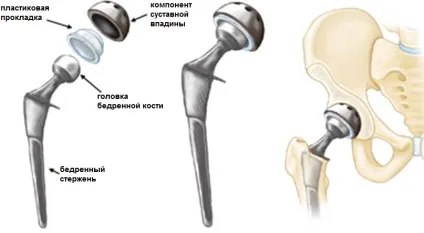 Перелом тазостегнового суглоба симптоми, лікування, реабілітація (тазостегнового) Перелом тазостегнового суглоба симптоми, лікування, реабілітація