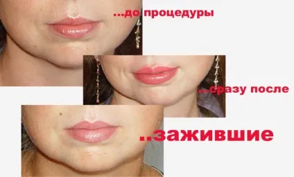 Татуаж губ з розтушовуванням як вибрати колір, скільки заживає, фото і відео поради (заживає) Татуаж губ з розтушовуванням як вибрати колір, скільки заживає, фото і відео поради