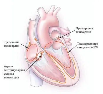 Тахікардія, лікування народними засобами (тахікардія) Тахікардія, лікування народними засобами
