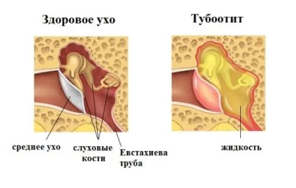 Тубоотит у дитини симптоми і лікування (купірування вогнища інфекції) Тубоотит у дитини симптоми і лікування