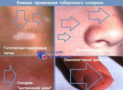 Туберозний склероз у дітей
