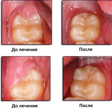 Видалення капюшона зуба мудрості - ціна, відгуки та загоєння після операції (мудрості) Видалення капюшона зуба мудрості - ціна, відгуки та загоєння після операції
