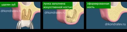 Видалення зубів перед імплантацією, доктор Кондратьєв (гранулами штучної кістки) Видалення зубів перед імплантацією, доктор Кондратьєв