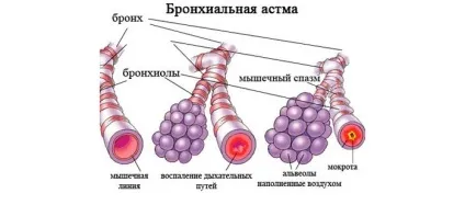 Задуха і задишка при бронхіальній астмі симптоми, як зняти і що робити (задишка) Задуха і задишка при бронхіальній астмі симптоми, як зняти і що робити