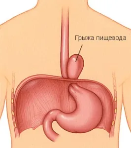 Стравохід - хвороби і симптоми, пов'язані з ним; їх лікування (лікування) Стравохід - хвороби і симптоми, пов'язані з ним; їх лікування