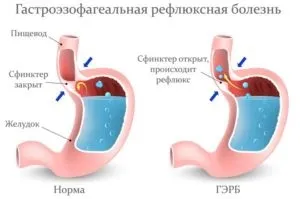 Стравохід - хвороби і симптоми, пов'язані з ним; їх лікування (хвороби) Стравохід - хвороби і симптоми, пов'язані з ним; їх лікування