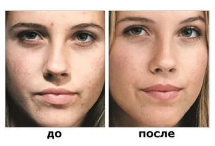 Пілінг фруктовими кислотами (фруктовий пілінг) - відгуки, в домашніх умовах, ціни, фото до і після (фото) Пілінг фруктовими кислотами (фруктовий пілінг) - відгуки, в домашніх умовах, ціни, фото до і після
