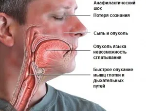 Укуси комах на шкірі людини що робити якщо почервоніння, свербіж, пухлина, набряк (шкірі) Укуси комах на шкірі людини що робити якщо почервоніння, свербіж, пухлина, набряк