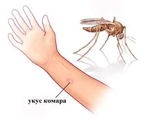 Укус комара як зняти набряк, лікування, допомога дітям - my life (комара) Укус комара як зняти набряк, лікування, допомога дітям - my life