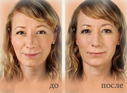 Уколи краси, ін'єкційна косметологія (уколи) Уколи краси, ін'єкційна косметологія