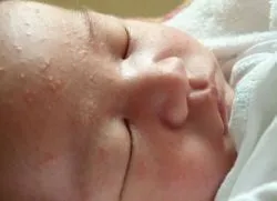 У дитини прищики на обличчі