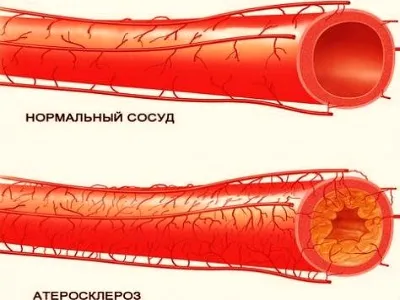 Ущільненнястінок аорти серця що це означає (ущільнення) Ущільненнястінок аорти серця що це значить