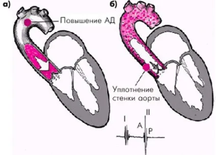 Ущільненнястінок аорти причини, симптоми і лікування (Ущільненнястінок аорти) Ущільненнястінок аорти причини, симптоми і лікування