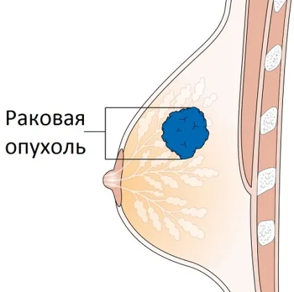 Ущільнення в молочній залозі від чого з'являється і чим загрожує (чого) Ущільнення в молочній залозі від чого з'являється і чим загрожує